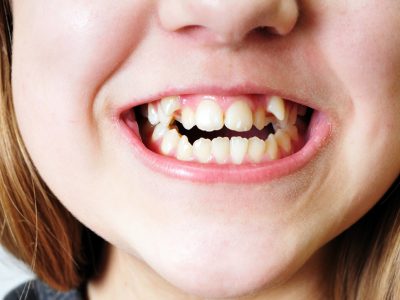 تقويم الاسنان, ابتسامة المشاهير, هووليود سمايل, تبييض الاسنان, تنظيف الاسنان, علاج الاسنان, افضل اخصائي تقويم الاسنان في ابوظبي, اجمل ابتسامة في ابوظبي